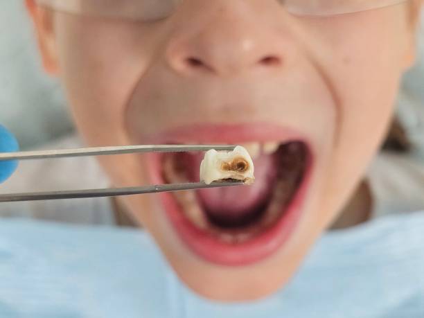 Best Emergency Tooth Extraction in Manila, AR